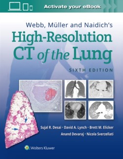 Webb, Muller and Naidichs High-Resolution CT of the Lung